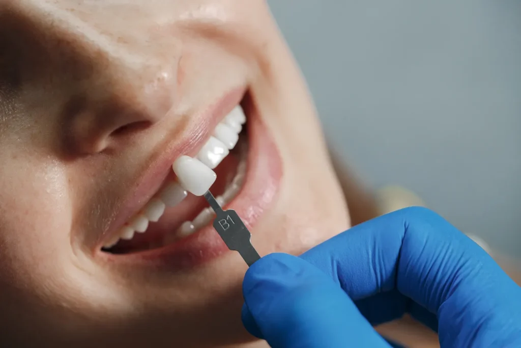 Facetas Dentarias 1 (2) 2